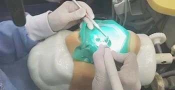 Instalação de Pinos de Fibra de Vidro - Blindagem Coronária